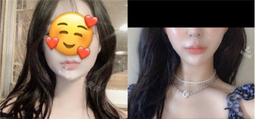 韩国歌娜做整形怎么样，本地客户超多擅长做提升和3D隆鼻