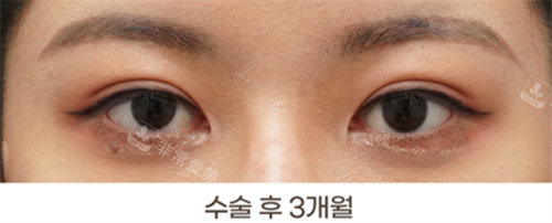 韩国得芘芘整形外科双眼皮术后图