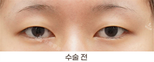韩国得芘芘整形外科双眼皮术前图