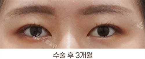 韩国得芘芘整形外科双眼皮术后图