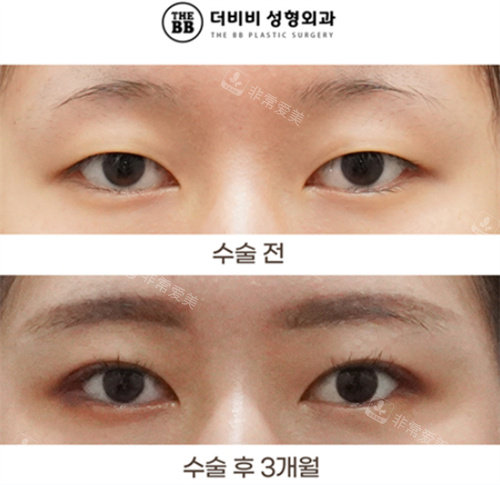 韩国得芘芘整形外科双眼皮手术对比图