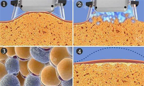 超声波吸脂图片