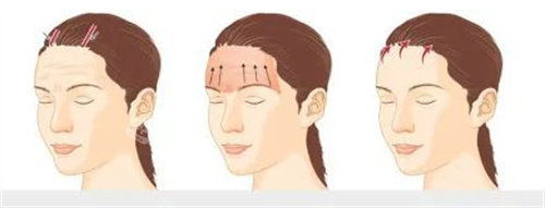 額頭提升手術(shù)示意圖 額頭提升手術(shù)示意圖