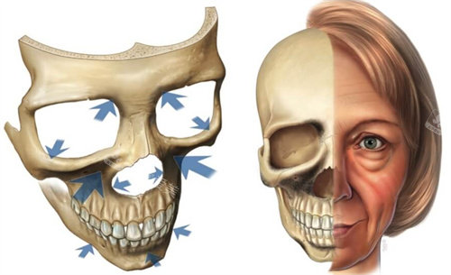 面部骨骼出现吸收情况模拟图