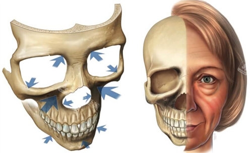 面部骨骼出現(xiàn)吸收情況模擬圖