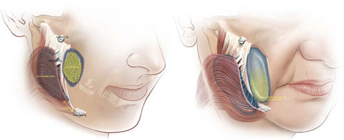 年轻时的面颊组织与衰老面部组织对比图