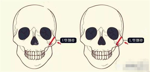 顴骨整形示意圖 顴骨整形示意圖