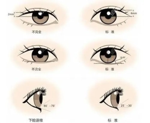 標準的雙眼皮形態(tài) 標準的雙眼皮形態(tài)