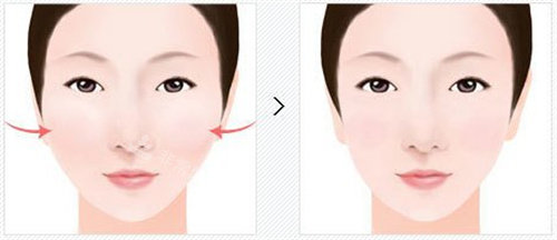 颧骨缩小术后变化图 颧骨缩小术后变化图