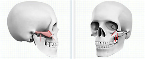 顴骨截骨方法展示圖