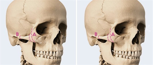 顴骨縮小手術(shù)方案設(shè)計(jì)圖