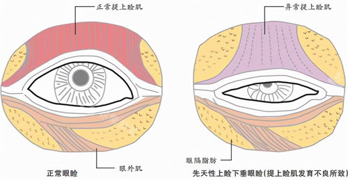 眼睑下垂示意图.jpg