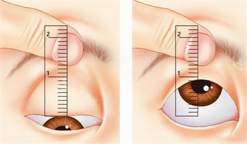 上眼睑手术图.jpg