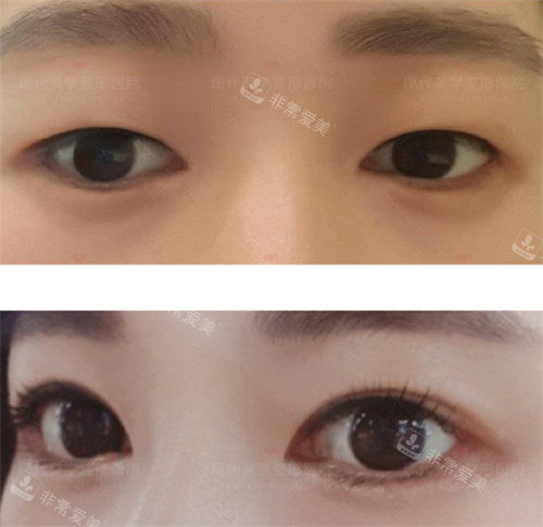 韩国现代美学整形双眼皮手术对比