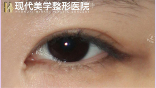 韓國現(xiàn)代美學(xué)整形眼部整形圖 韓國現(xiàn)代美學(xué)整形眼部整形圖