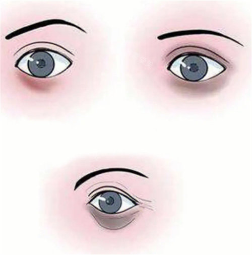 黑眼圈程度图.jpg