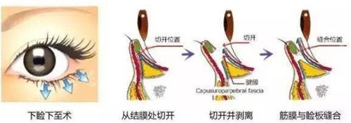 眼瞼下至手術過程圖.jpg 眼瞼下至手術過程圖.jpg