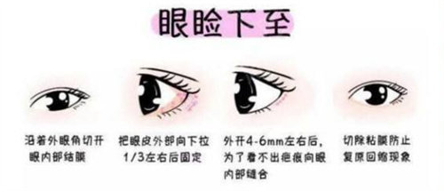 眼瞼下至圖片.jpg 眼瞼下至圖片.jpg