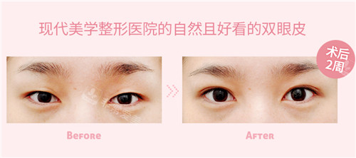 韓國(guó)現(xiàn)代美學(xué)整形眼整形對(duì)比照 韓國(guó)現(xiàn)代美學(xué)整形眼整形對(duì)比照