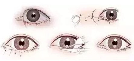 眼角整形手术步骤图