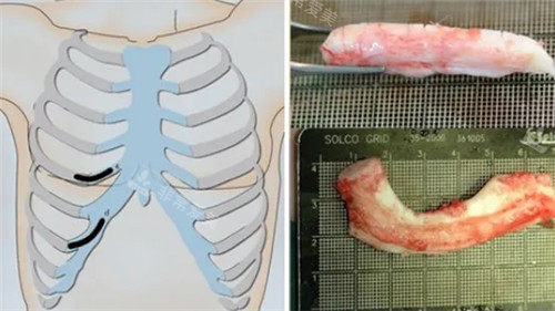 隆鼻手術材料圖示