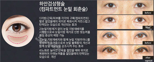 韩国will整形眼部手术图
