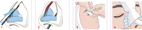 隆鼻手術(shù)操作圖.jpg