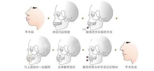 雙鄂手術(shù)過(guò)程圖