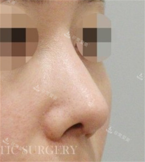 韩国真谈整形外科鼻修复术后图
