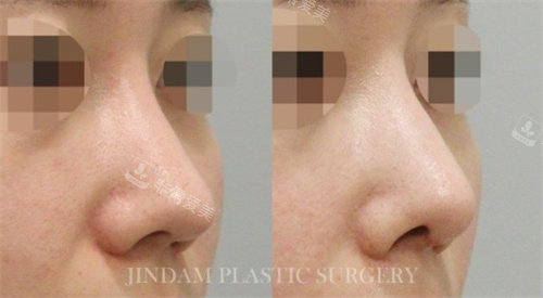 韩国真谈整形外科鼻修复手术对比图