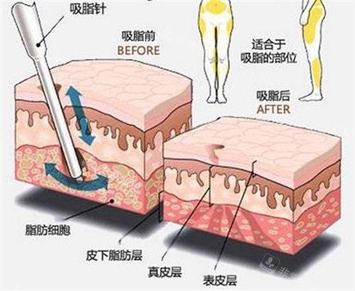 吸脂前后对比图