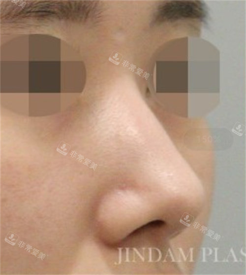 韩国真谈整形外科鼻修复术前图