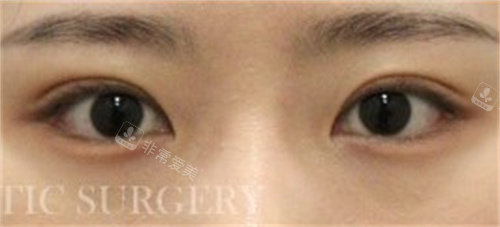 韩国真谈整形双眼皮手术后图片