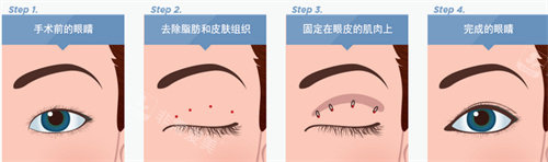 雙眼皮手術(shù)流程圖 雙眼皮手術(shù)流程圖