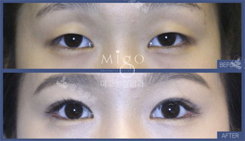 韩国大眼睛整形双眼皮手术对比图