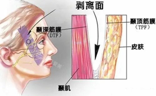 筋膜剥离面示意图