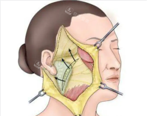 拉皮手術(shù)示意圖 拉皮手術(shù)示意圖