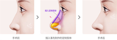 韩国乐日整形隆鼻方法图