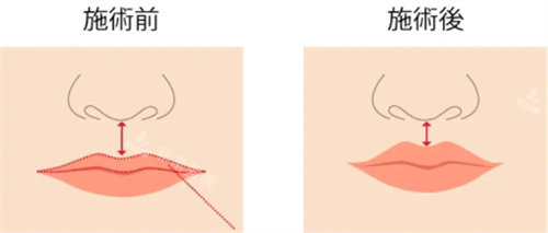 人中縮短術(shù)前術(shù)后圖片