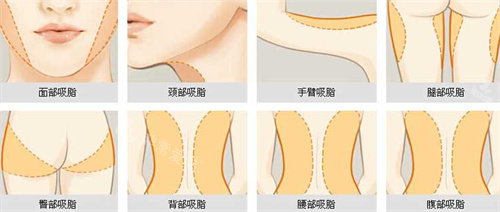 身体吸脂位置展示图