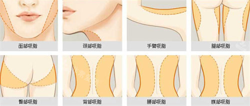 身体吸脂部位展示图 身体吸脂部位展示图