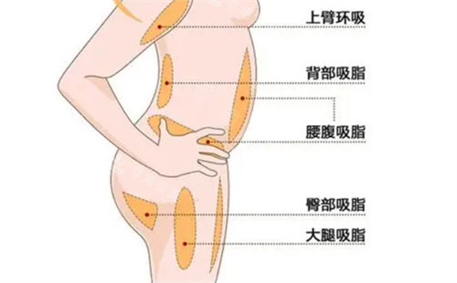 局部吸脂位置参考图 局部吸脂位置参考图