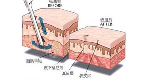 吸脂前后皮肤层变化图 吸脂前后皮肤层变化图