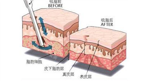 吸脂前后皮肤层变化图