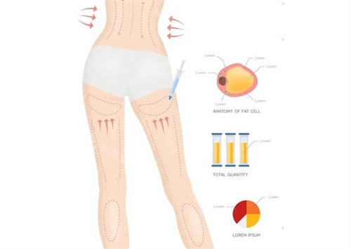 吸脂瘦大腿动画展示图 吸脂瘦大腿动画展示图