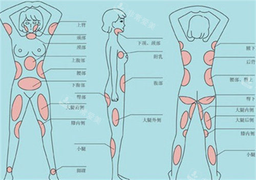 身体吸脂部位详细解说图 身体吸脂部位详细解说图