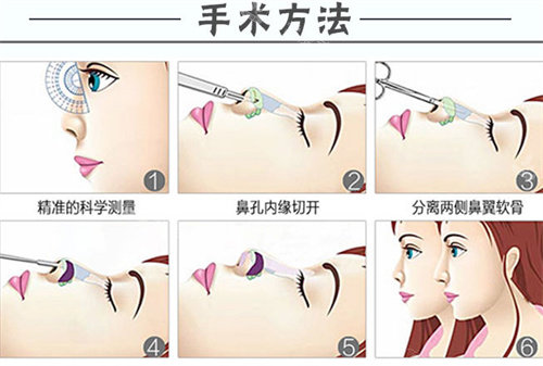 隆鼻手术方法图 隆鼻手术方法图