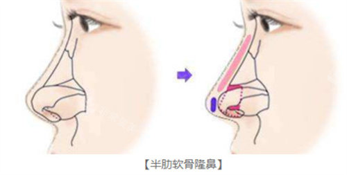 半肋骨隆鼻参考图