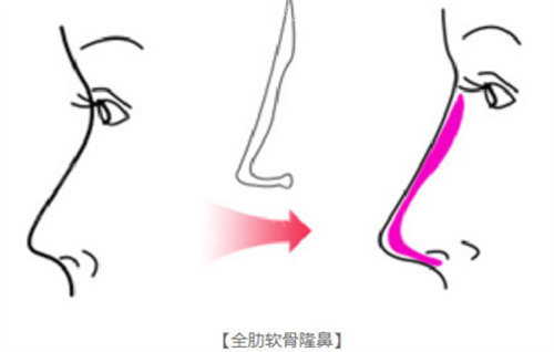 全肋骨隆鼻展示图