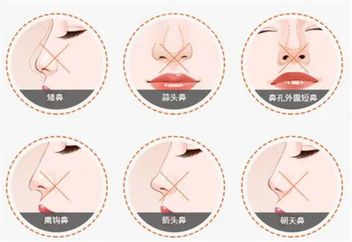 需要做鼻部矫正情况参考图 需要做鼻部矫正情况参考图